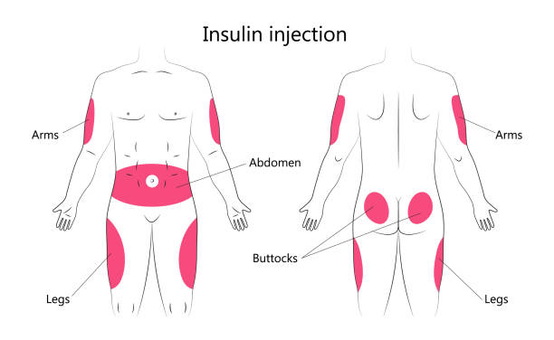 Injection Sites Insulin Photos