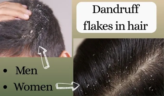 dandruff cause Hair Fall Root 