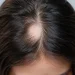 Alopecia Areata: Causes, Symptoms, Hair Loss Treatment & Prevention Guide - Bitudi